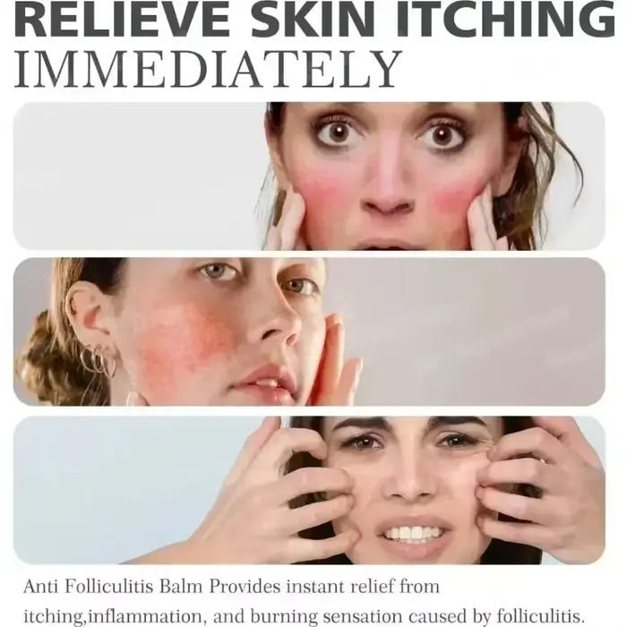 Crème Anti-acné élimine efficacement les Nodules de la peau Pustules Cysts Papules points noirs hommes et femmes acné