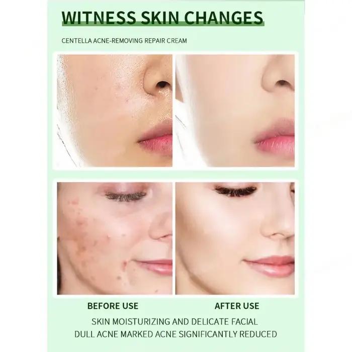 Crème Anti-acné élimine efficacement les Nodules de la peau Pustules Cysts Papules points noirs hommes et femmes acné