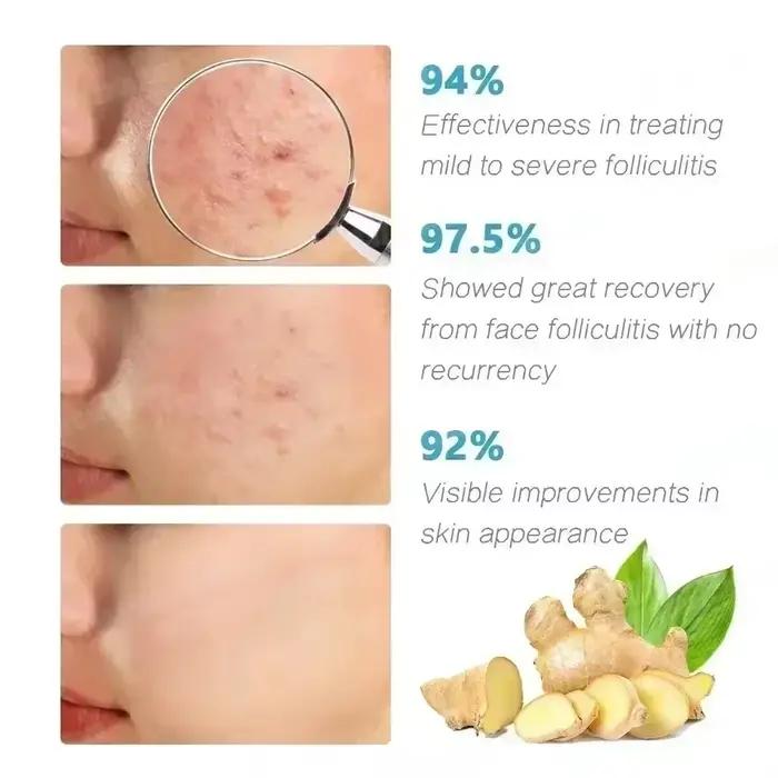3ème crème Anti-acné efficace élimine les Nodules de la peau Pustules Cysts Papules points noirs hommes et femmes acné