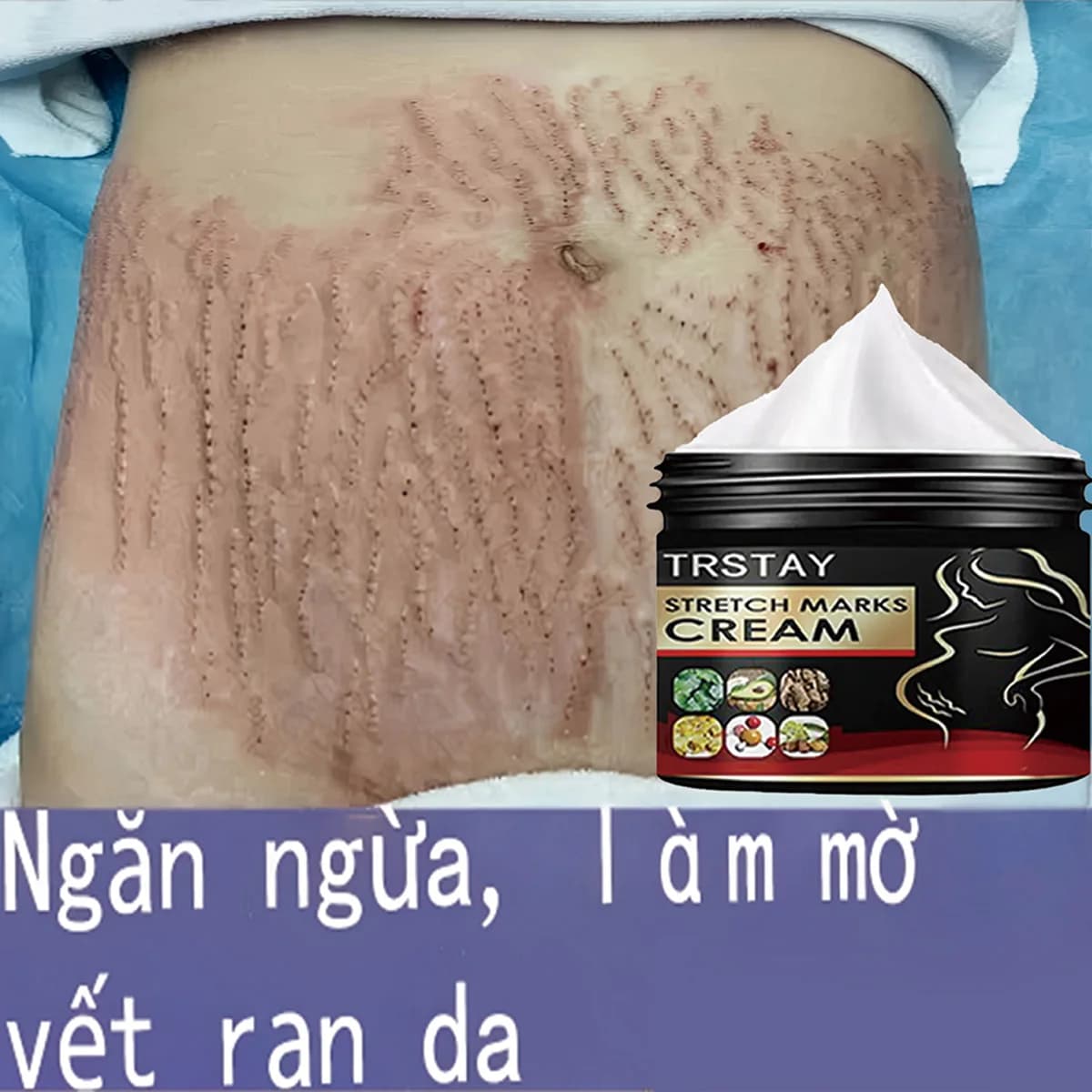TRSTAY crème contre les vergetures pour la peau de grossesse reconstituer et réparer la Promotion de