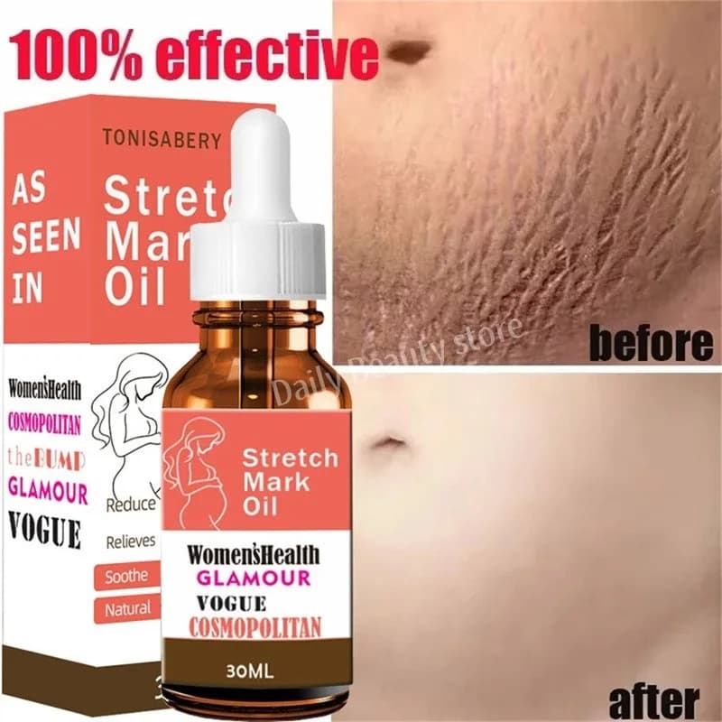 Dissolvant de vergetures, huile essentielle, grossesse, maternité, corps, nouveau vieux sérum d'élim