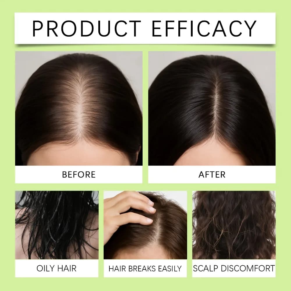 Kit de soin capillaire nourrissant pour le cuir chevelu avec rouleau à micro-aiguilles, réduit la perte de cheveux, renforce les racines des cheveux, soin quotidien.