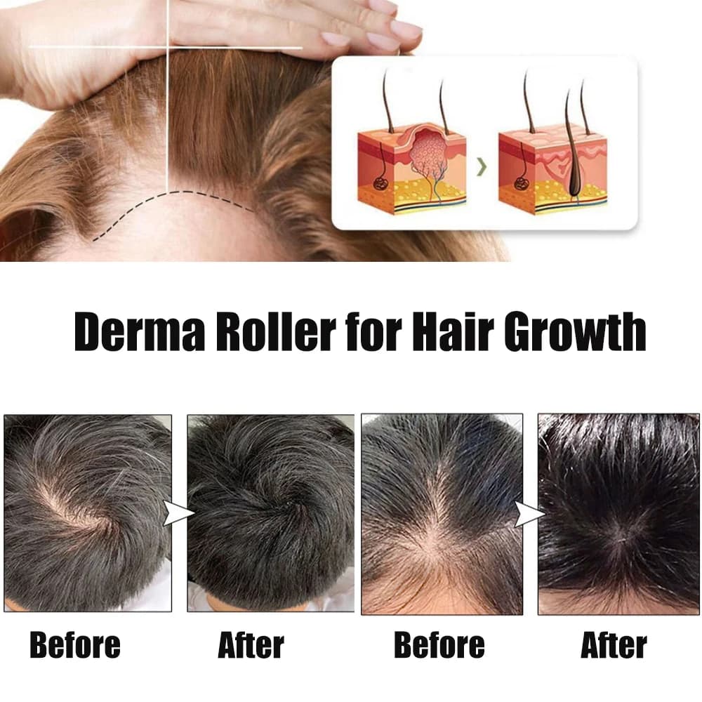 Rouleau Derma professionnel 540 pour la croissance des cheveux et de la barbe