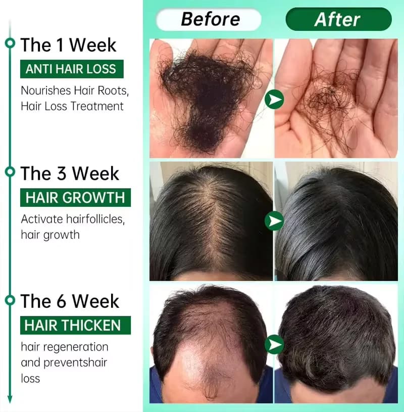 Spray rapide pour la croissance des cheveux au gingembre, Anti-chute des racines, sérum pour la repousse des cheveux, réparation endommagée du cuir chevelu, produits de soins nourrissants pour femmes 