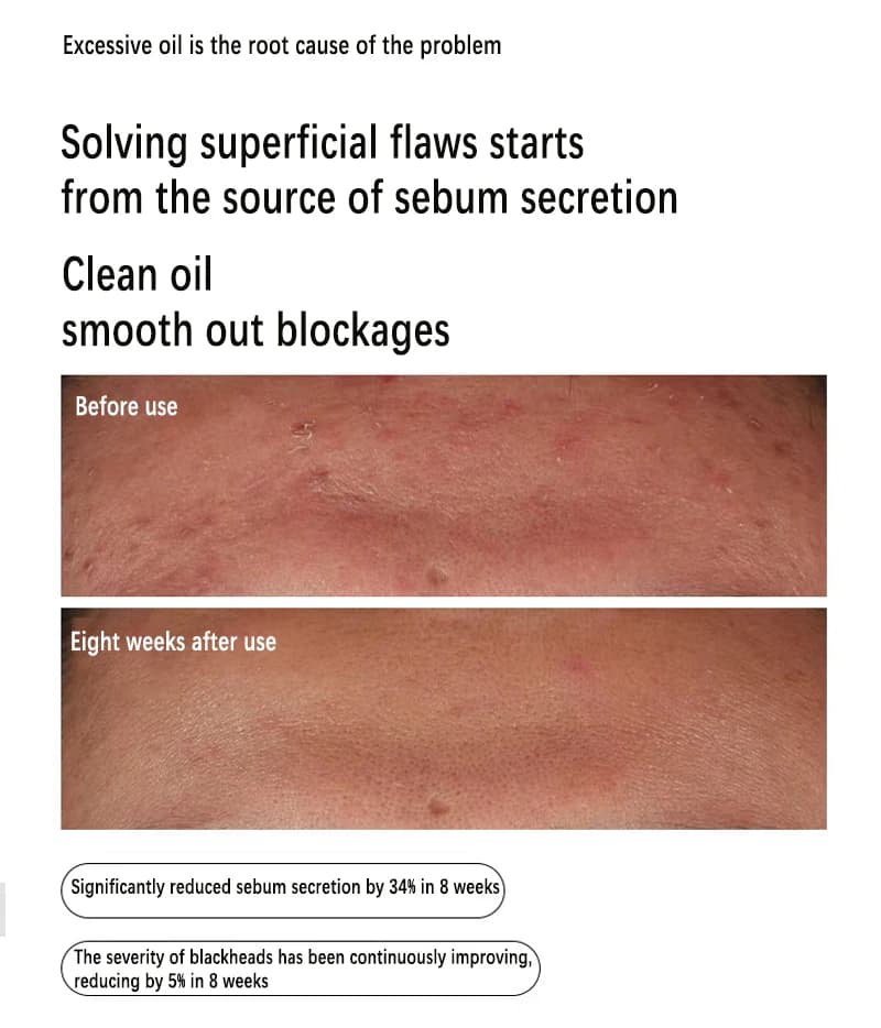 Sérum à la niacinamide 10% + zinc 1% 30 ml Contrôle du sébum Élimine l'acné et éclaircit les peaux grasses Exfoliant doux Essence à pores resserrés