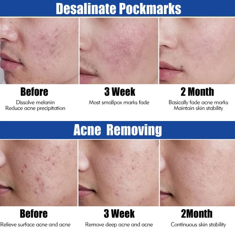 Sérum Origing pour traitement de l'acné, 100% EGF, Essence naturelle Pure, nettoyage efficace, dissolvant d'acné sévère, réparation des boutons, blanchiment de la peau