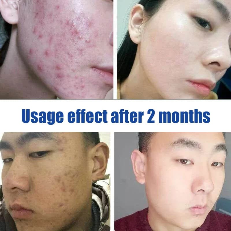 Sérum Origing pour traitement de l'acné, 100% EGF, Essence naturelle Pure, nettoyage efficace, dissolvant d'acné sévère, réparation des boutons, blanchiment de la peau