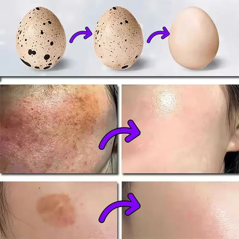 Sérum à la vitamine B3 pour estomper les taches brunes, le chloasma, éclaircir la pigmentation mélanique, lisser les pores, rajeunir, éclaircir et hydrater la peau
