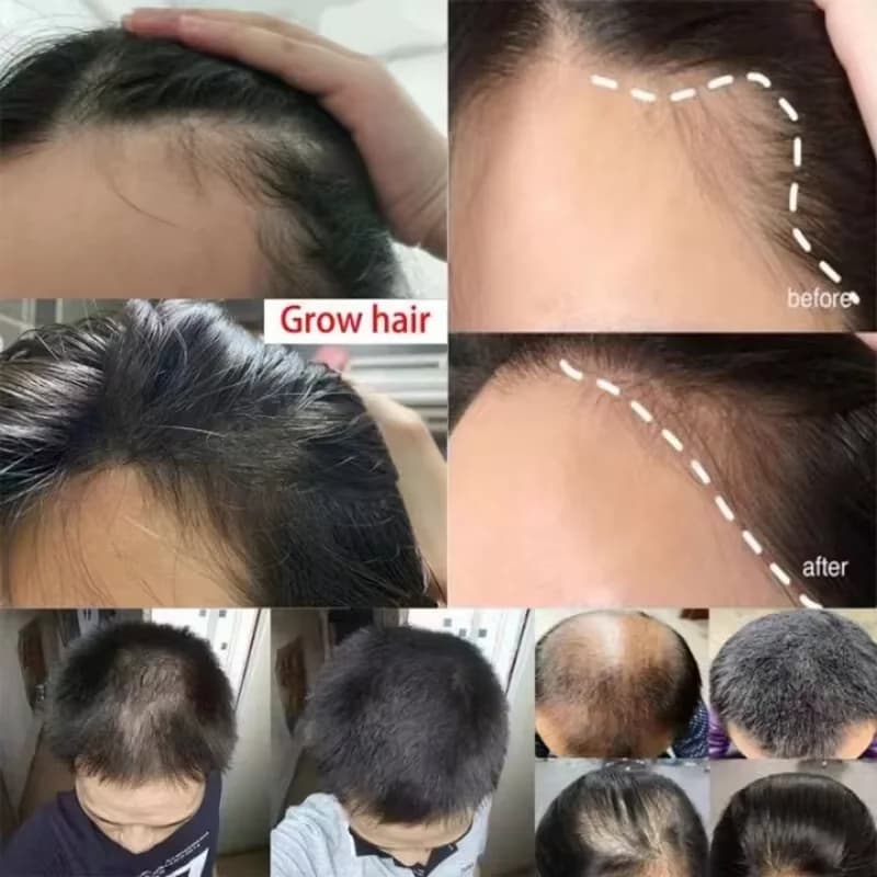 Spray rapide pour la croissance des cheveux au gingembre, Anti-chute des racines, sérum pour la repousse des cheveux, réparation endommagée du cuir chevelu, produits de soins nourrissants pour femmes 