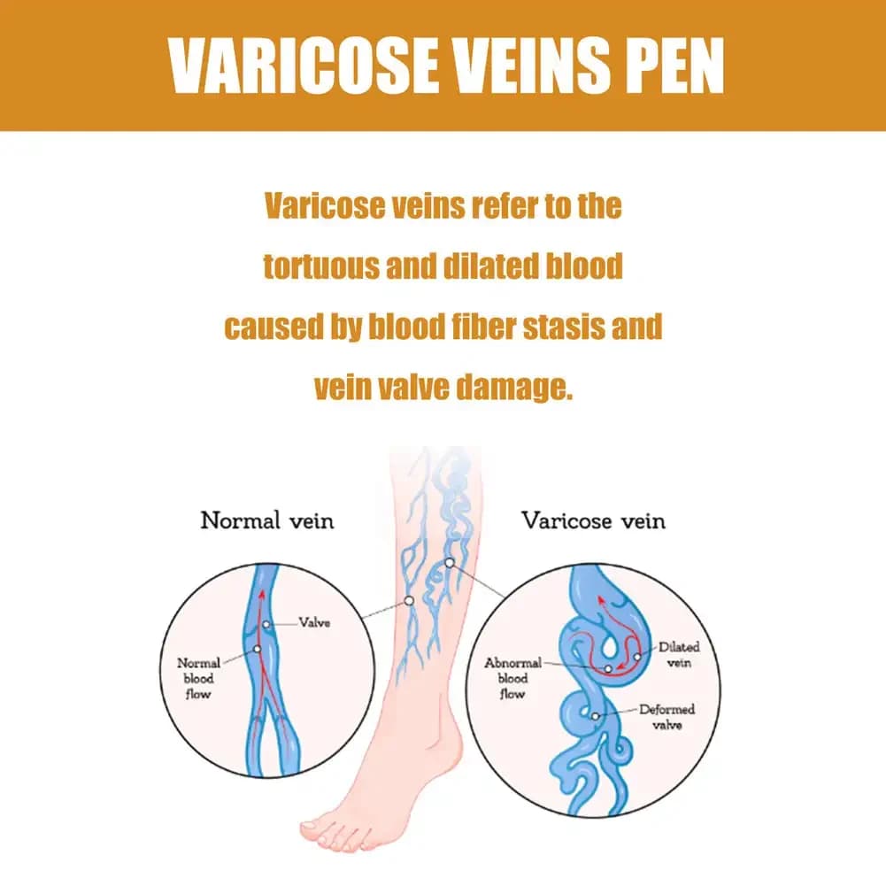 Abat-jour thérapie varices soulagement efficace de la vascularite dilatée dans les jambes phlébite améliorer la Circulation sanguine santé