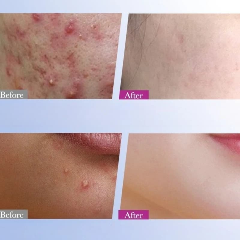 8/16 Patchs Étoiles Colorés pour l'Acné – Améliore la Peau des Femmes – Outil Hydrocolloïde Anti-Acné – Couvre les
