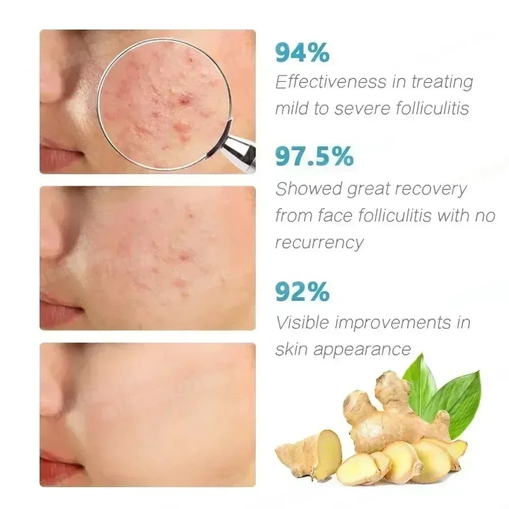 3ème crème Anti-acné efficace élimine les Nodules de la peau Pustules Cysts Papules points noirs hommes et femmes acné soin de la peau crème Essence