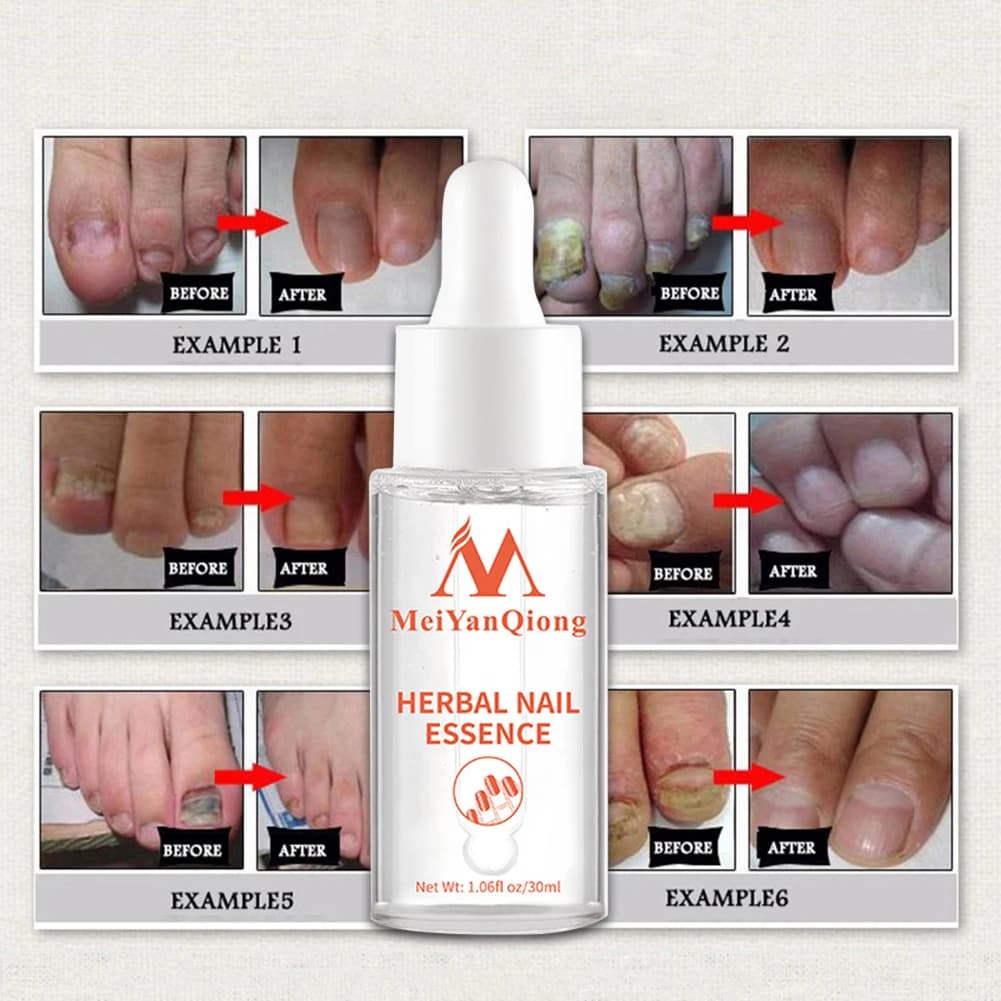 Essence réparatrice d'ongles à base de plantes 30 ml