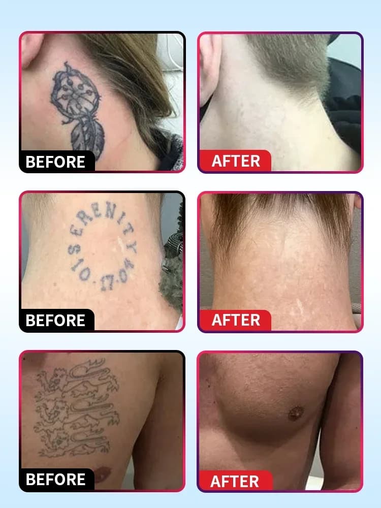 Huile essentielle pour détatouage, adaptée aux tatouages grands et petits, élimine efficacement les tatouages permanents