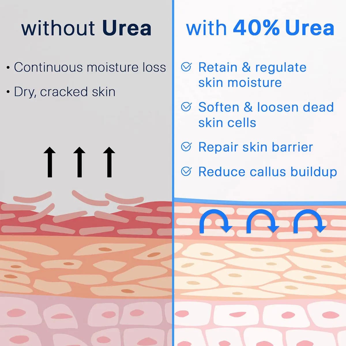 Crème pour les mains à l'urée et à l'acide salicylique, contenant de l'huile d'arbre à thé, de l'urée, d'acide salicylique et d'aloe vera, hydrate les mains et les pieds