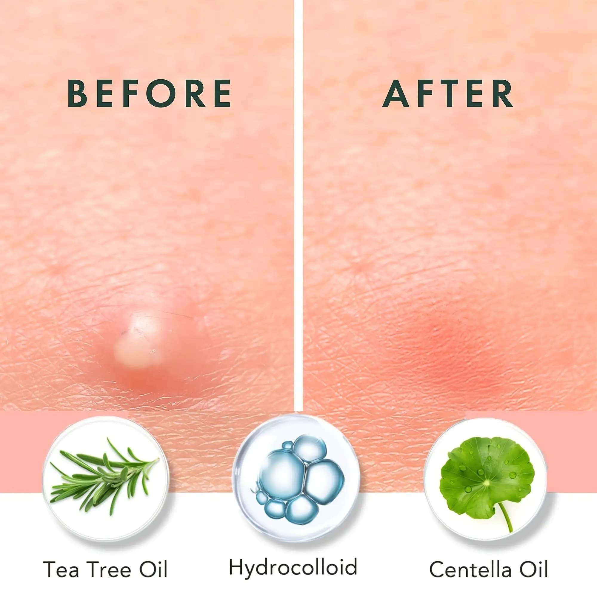 Patch anti-acné à l'huile essentielle d'arbre à thé 12/36 Hydrogel, efficace contre l'acné