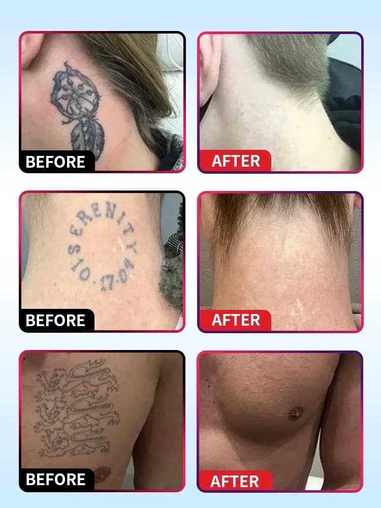 Huile essentielle pour détatouage, adaptée aux tatouages grands et petits, élimine efficacement les tatouages permanents