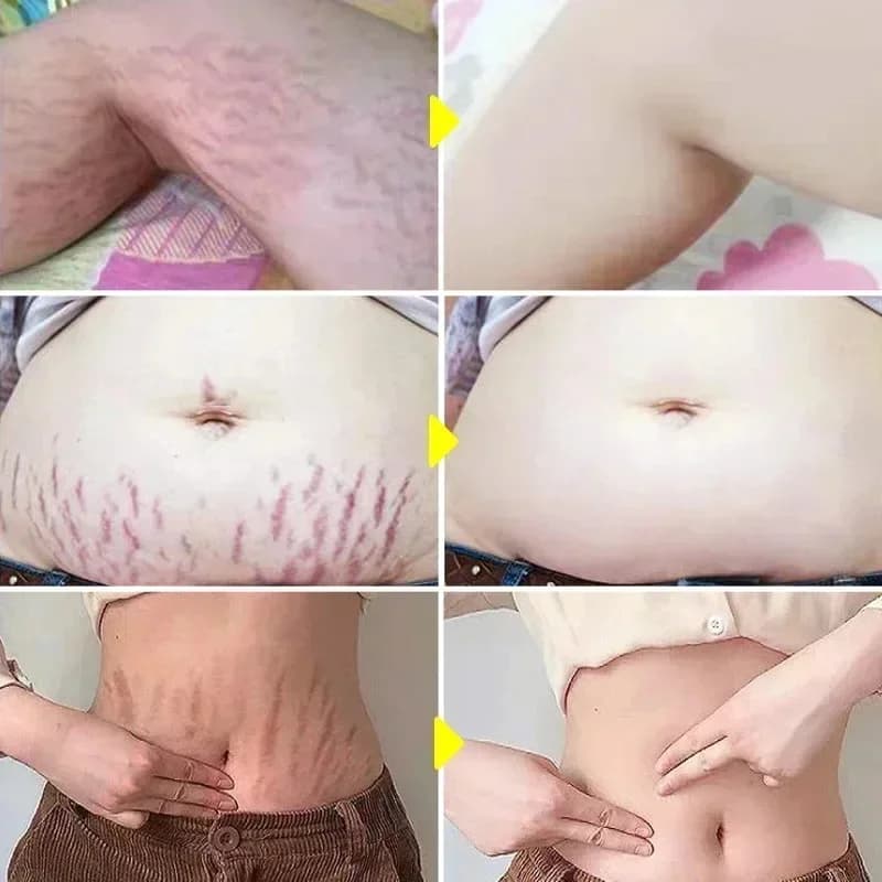 Crème d'élimination permanente des vergetures