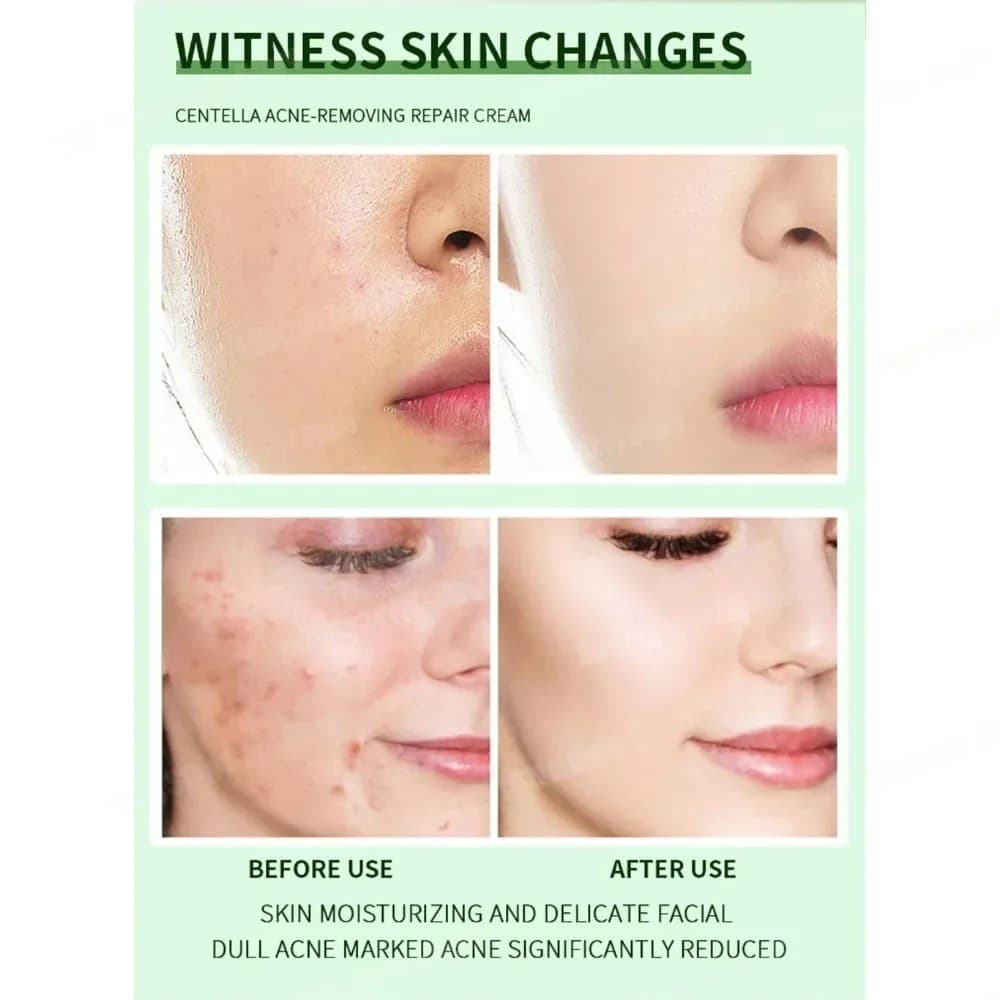 Crème Anti-acné élimine efficacement les Nodules de la peau Pustules Cysts Papules points noirs hommes et femmes acné crème d'essence de soin de la peau