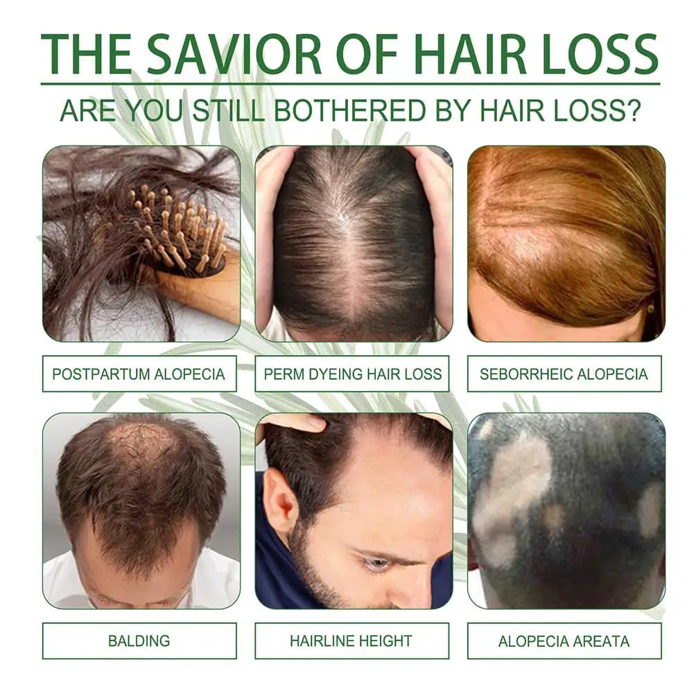 Huile essentielle de romarin pour la croissance des cheveux, AMP, améliore la perte de cheveux, nourrit, renforce les racines, traitement du cuir chevelu, soins capillaires
