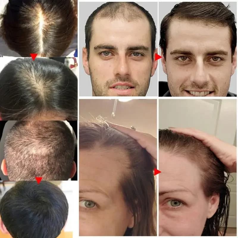 Sérum de croissance rapide des cheveux pour femmes et hommes, prévention de la perte de cheveux, repousse des cheveux, huile essentielle, réparation des racines des cheveux endommagés, soins capillair