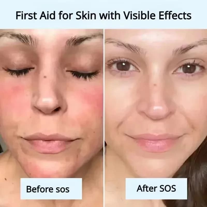 Masque Réparateur Anti-Rougeurs Visage – Améliore Rapidement la Peau Sensible et Sèche – Sérum Hydratant Apaisant – Élimine les Rougeurs et la Rosacée – Soin de Beauté