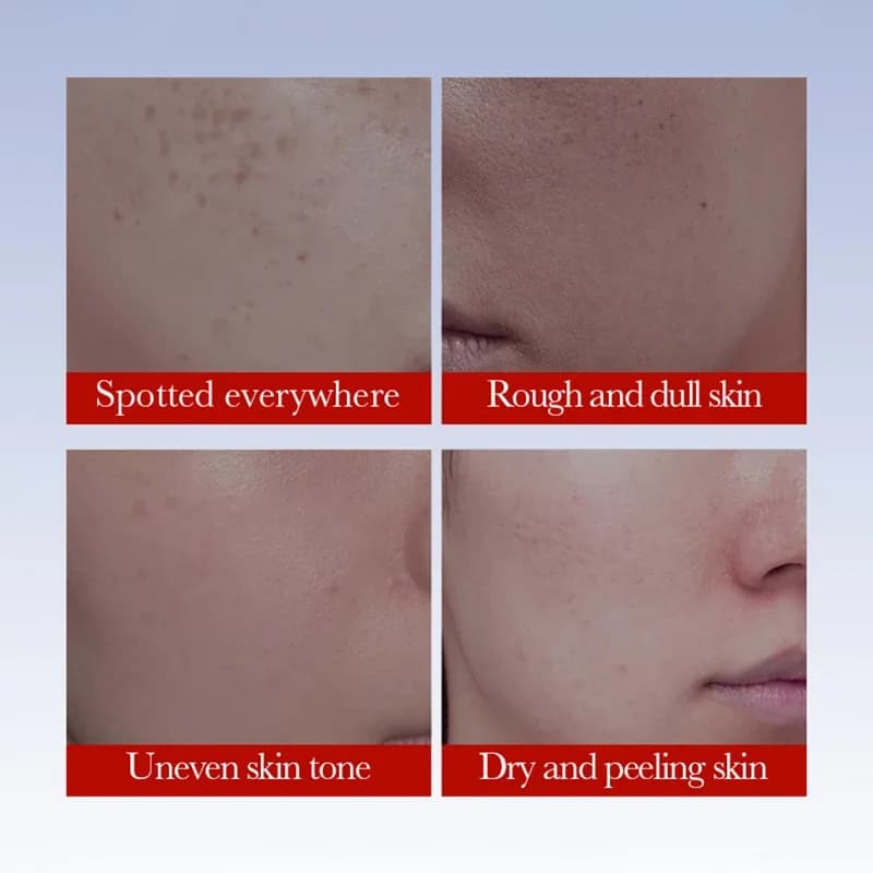 SADOER crème Anti taches de rousseur crèmes blanchissantes pour le visage élimination