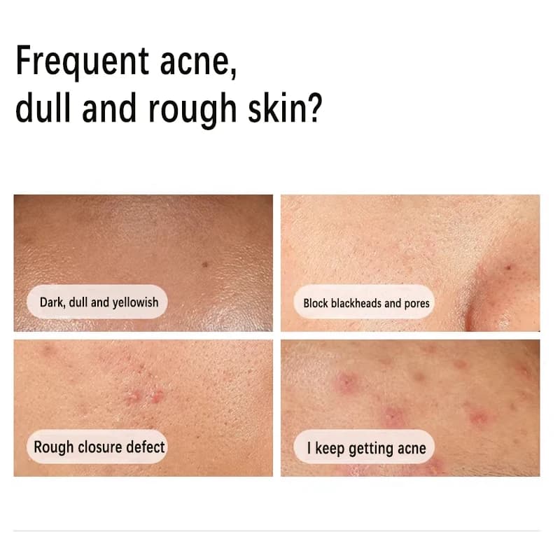 Sérum à la niacinamide 10% + zinc 1% 30 ml Contrôle du sébum Élimine l'acné et éclaircit les peaux grasses Exfoliant doux Essence à pores resserrés