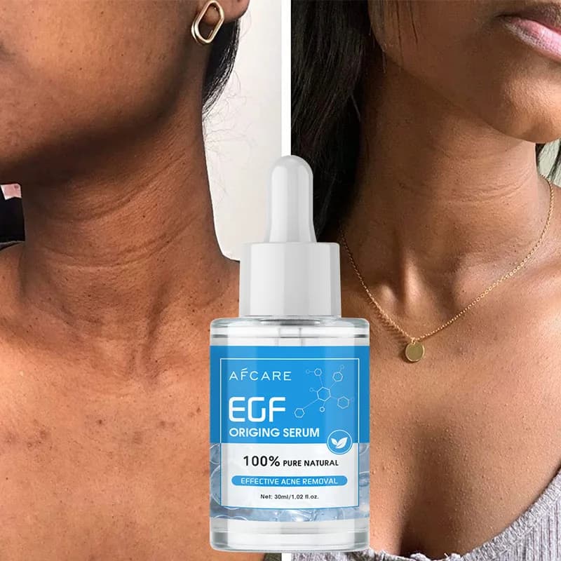 Sérum Origing pour traitement de l'acné, 100% EGF, Essence naturelle Pure, nettoyage efficace, dissolvant d'acné sévère, réparation des boutons, blanchiment de la peau