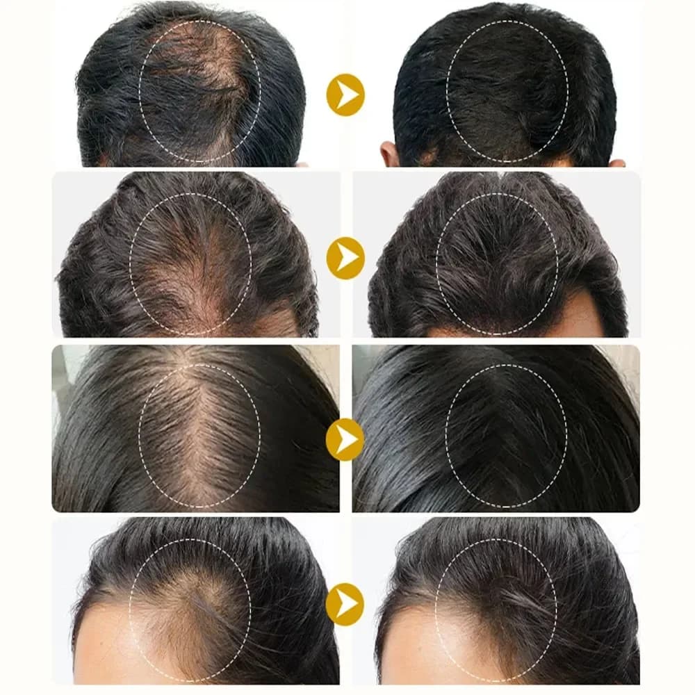 Spray rapide pour la croissance des cheveux au gingembre, Anti-chute des racines, sérum pour la repousse des cheveux, réparation endommagée du cuir chevelu, produits de soins nourrissants pour femmes 