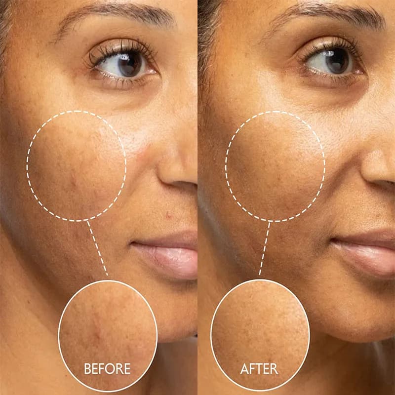 Sérum Origing pour traitement de l'acné, 100% EGF, Essence naturelle Pure, nettoyage efficace, dissolvant d'acné sévère, réparation des boutons, blanchiment de la peau