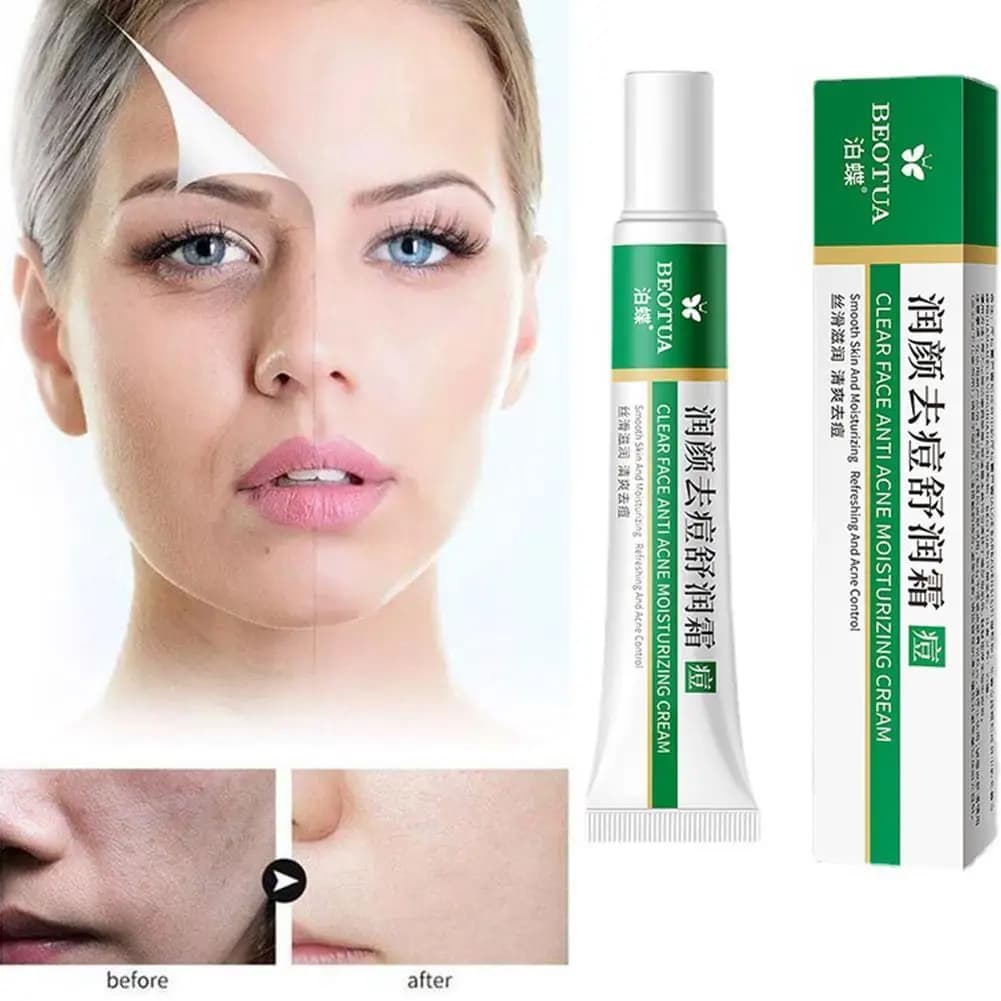 Crème de traitement de l'acné à base de plantes, nettoie, hydrate, répare, contrôle le sébum, resserre les pores, traitement des boutons, gel de soin de la peau