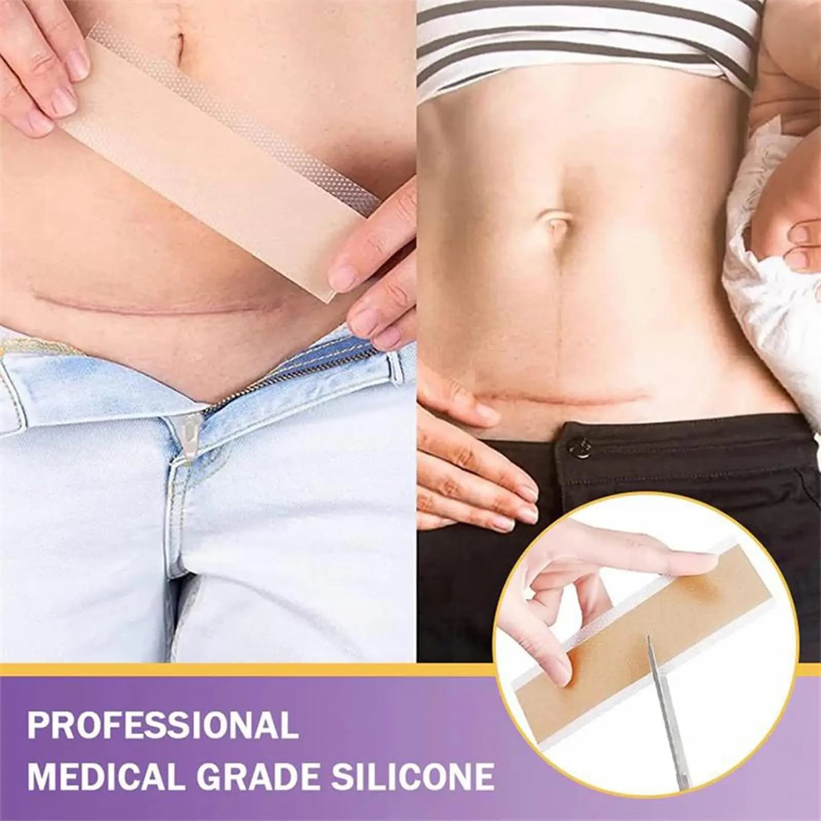 Feuille de cicatrice en Gel de Silicone souple chirurgical, Patch de traitement, bande d'élimination de l'acné, traumatisme, brûlure, couverture de cicatrice, Section de réparation de la peau, beauté 
