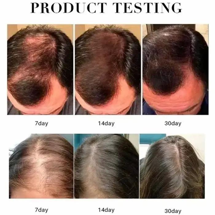 Huile essentielle naturelle anti-chute de cheveux pour femme