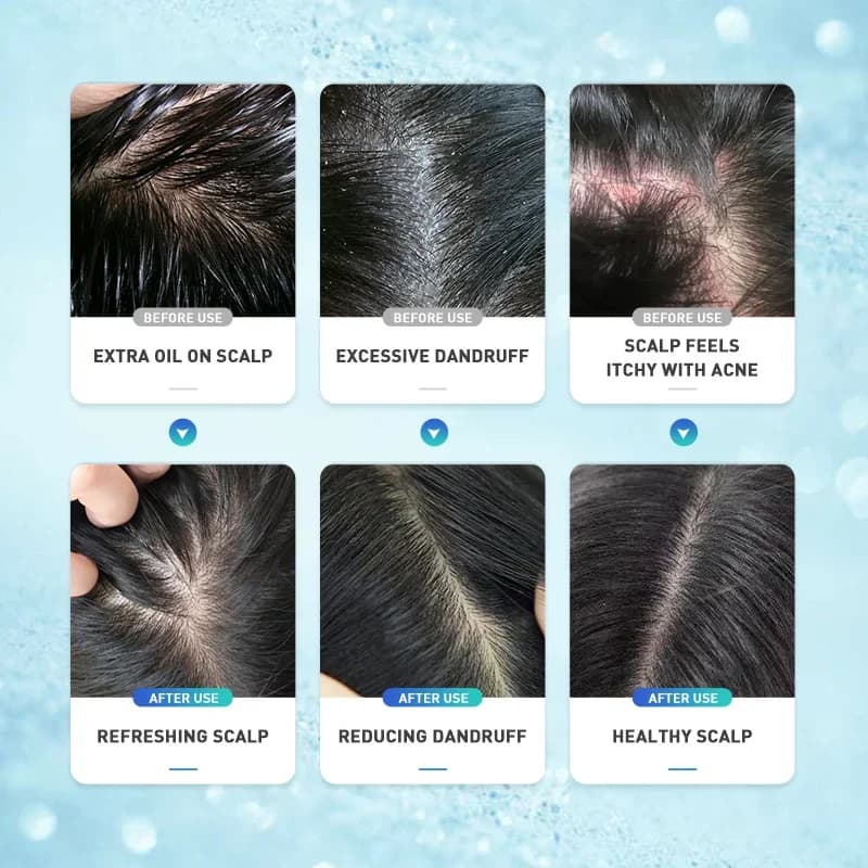 Shampoing antipelliculaire à l'acide salicVAC pour hommes et femmes