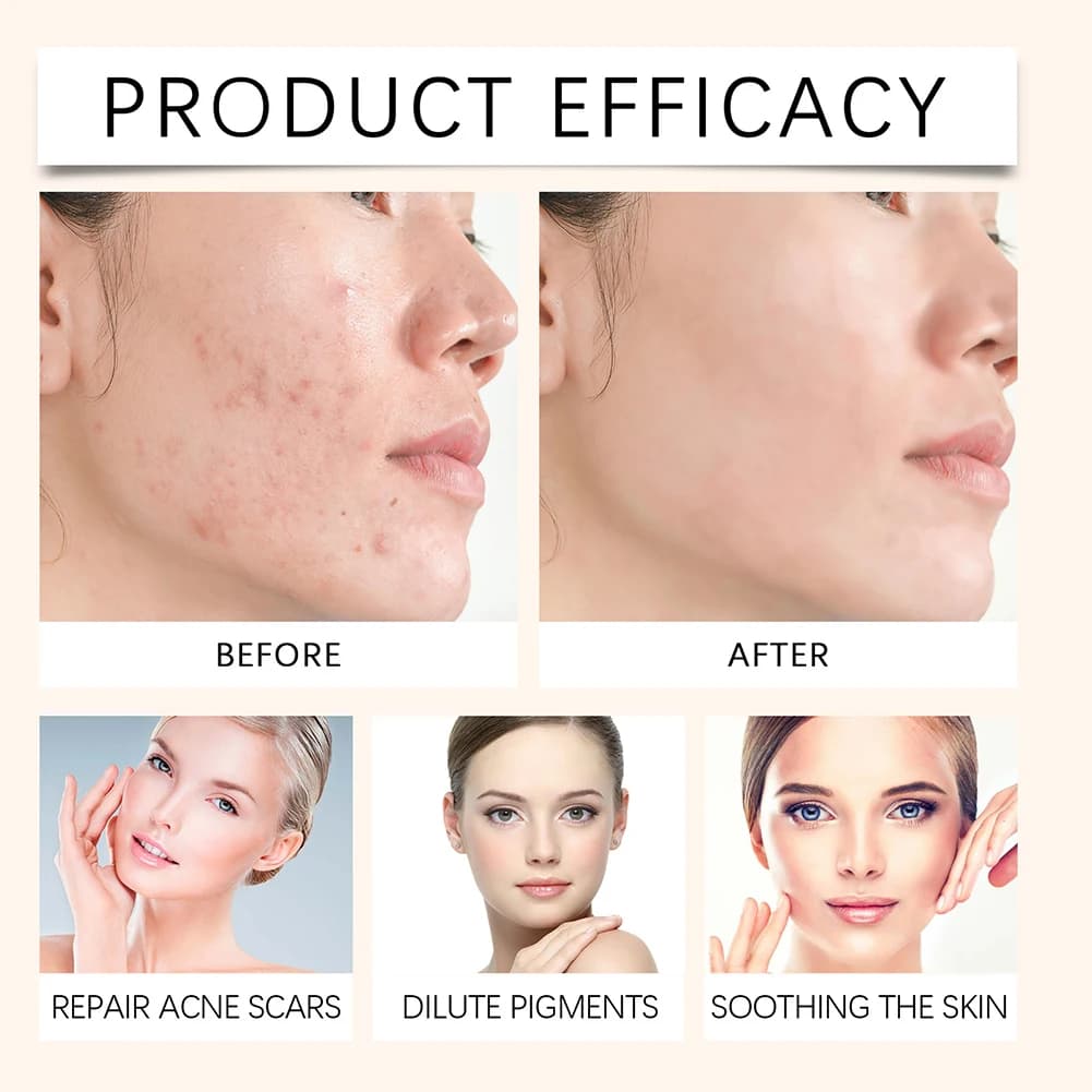 Crème pour le visage à l'extrait naturel de Calendula, 50g, pour l'acné hormonale, apaise les rougeurs, calme l'acné, crème à base de plantes pour peau grasse