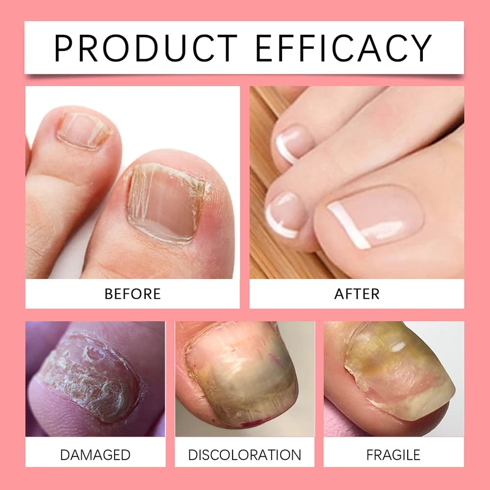 Solution de soin contre les champignons des ongles, Anti-Infection, réparation de l'onychomycose, ongles craquelés, main, pied, manucure, Essence de soins de santé, 15ml