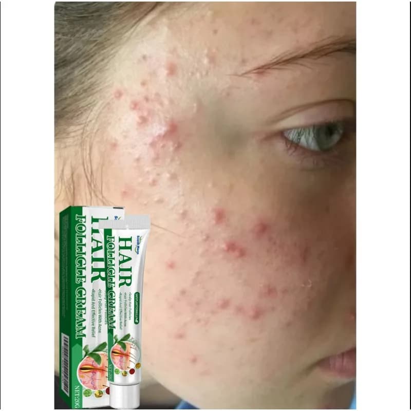 Crème Anti-acné élimine efficacement les Nodules de la peau Pustules Cysts Papules points noirs hommes et femmes acné crème d'essence de soin de la peau